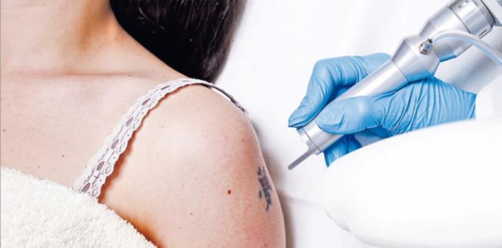 Los tatuajes no tienen por qué ser para siempre: cómo funciona su eliminación