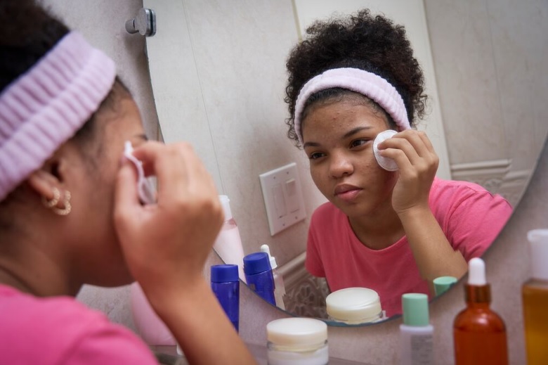 Acné en la adolescencia: qué ocurre realmente en la piel y cómo tratarlo correctamente