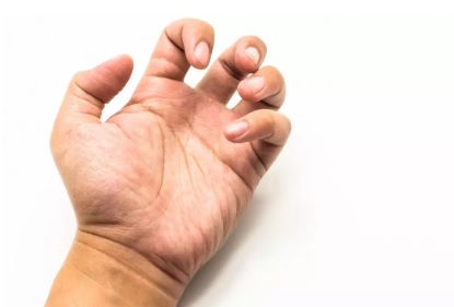 Espasticidad: qué es, cuáles son sus síntomas y cómo puede mejorar con fisioterapia