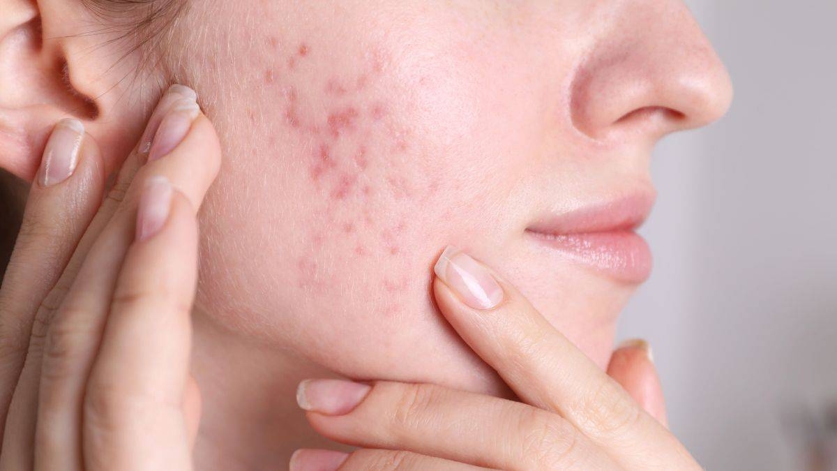 Acné adulto: cómo prevenir y tratar los brotes después de los 25 años