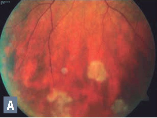 Uveítis no infecciosa: tratamiento a largo plazo para proteger la visión