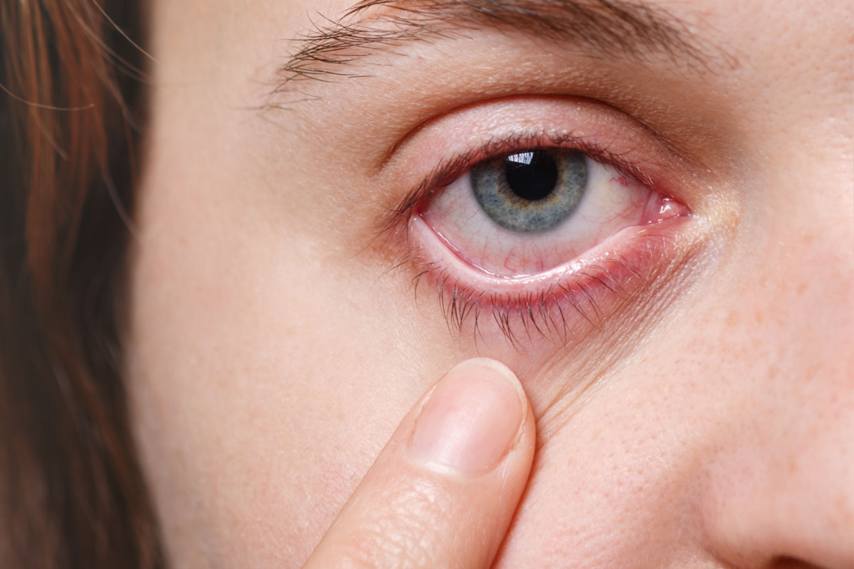 Entrecruzamiento corneal: nuevos avances en el tratamiento del queratocono y las enfermedades de la córnea