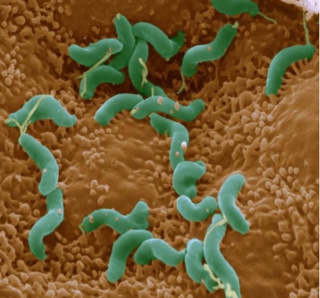 Del Helicobacter pylori al virus del papiloma humano: las infecciones relacionadas con el 12% de los cánceres del mundo