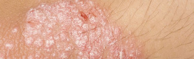 Psoriasis: qué es, síntomas, causas y tratamientos para controlar la enfermedad