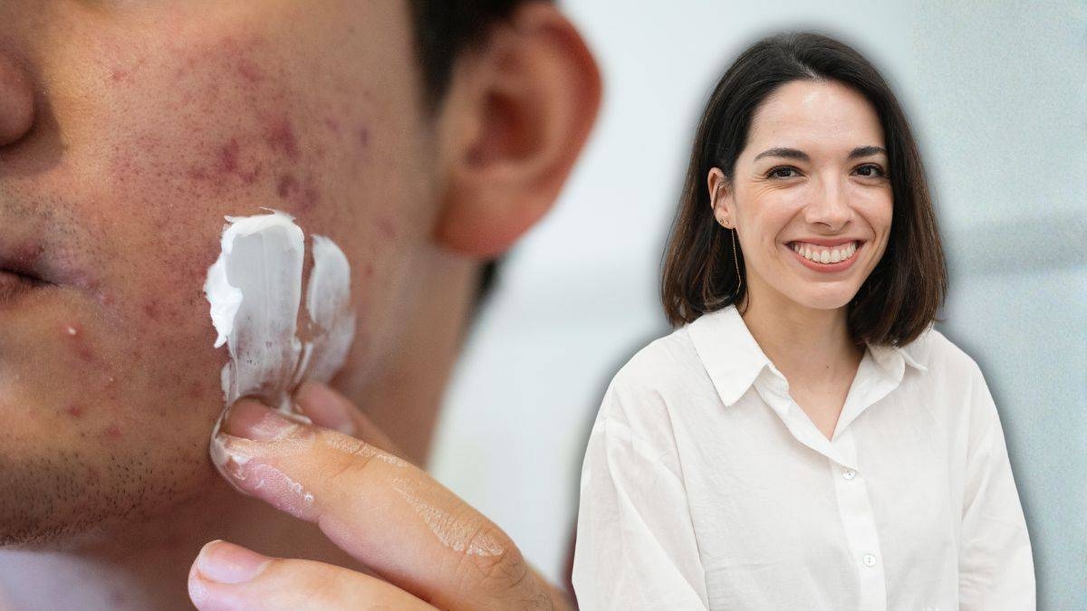 Acné en hombres adultos: causas, cuidados y tratamientos para una piel más sana