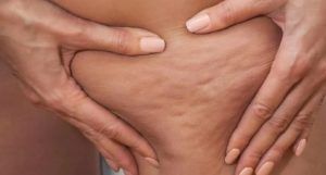 Prueba estos ejercicios infalibles para eliminar la celulitis en estas zonas tan complicadas de las piernas